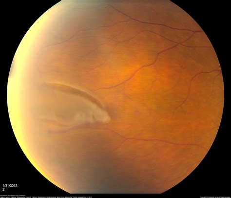 Retinal Tearhole Annan Retina Eye Center In Houston Texas