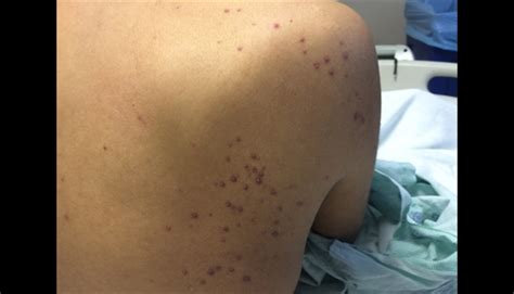 Erythematous Papules On Face And Torso Clinical Advisor
