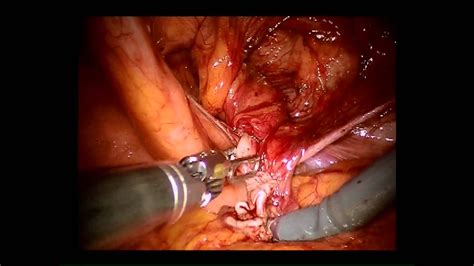 Robotic Assisted Inguinal Hernia Repair With Mesh Youtube