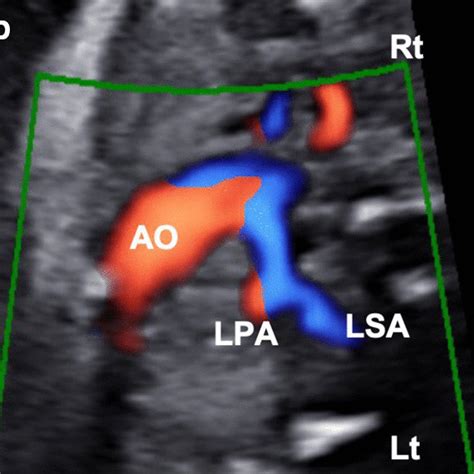 Prenatal Echocardiogram Showing An Atretic Main Pulmonary Artery Giving