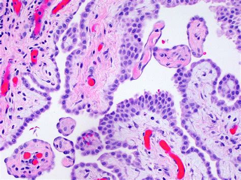 Pathology Outlines Well Differentiated Papillary Mesothelial Tumor