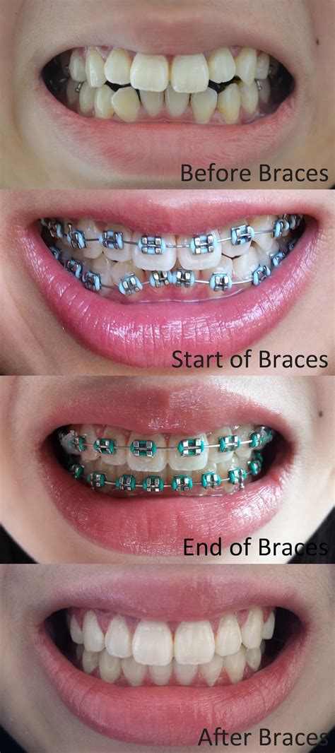 before and after braces before and after braces just on the bottom