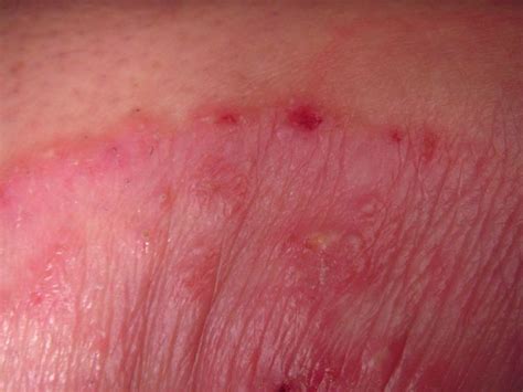 Armpit Rash Causes And Treatments
