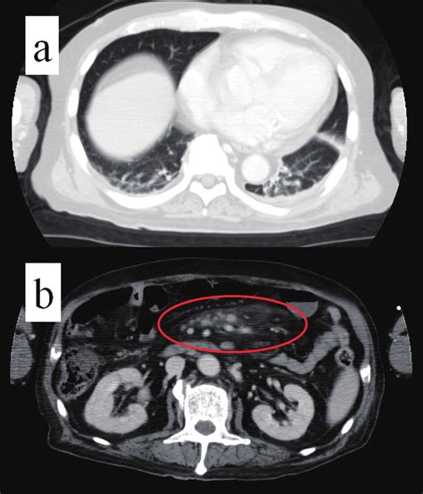 Contrast Enhanced Computed Tomography Ct Findings On Admission A
