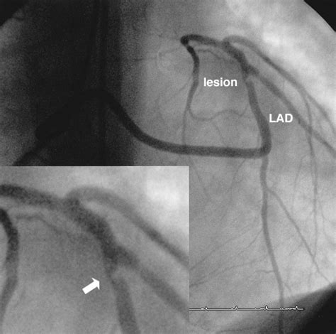 Primary Stenting Of An Anomalous Left Anterior Descending Coronary