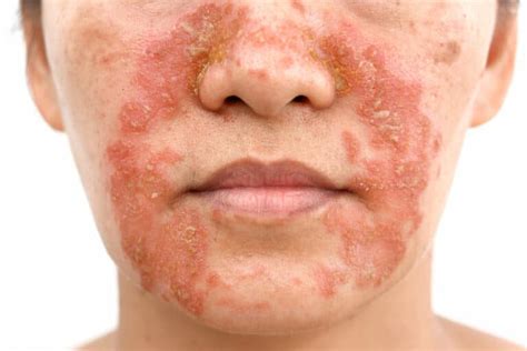 Dermatite Séborrhéique Causes Symptômes Et Traitements Information