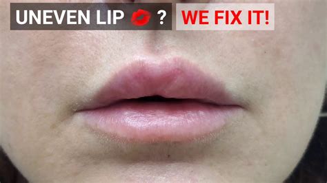 Correcting Uneven Lip Filler Using Hyaluronidase Youtube