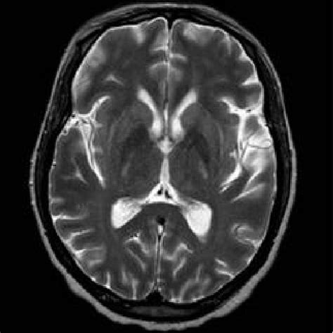 Brain Magnetic Resonance Imaging Showing Lentiform Sign Download