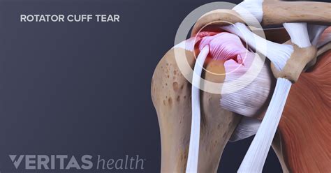 How Do Rotator Cuff Injuries Occur