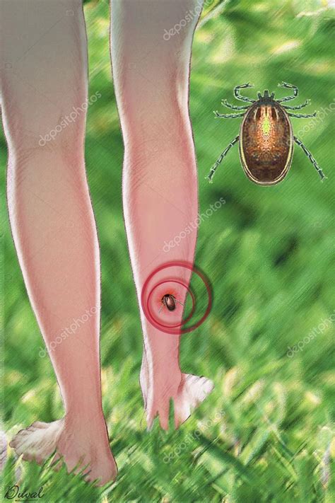 Lyme Disease Stock Photo By ©imagepointfr 44390391