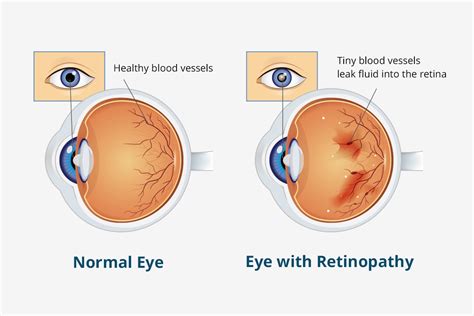 Diabetic Eye Disease Awareness Month Eye Q Vision Care