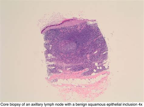 Pathology Outlines Axillary Lymph Nodes