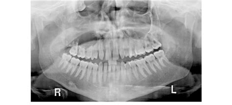 Panoramic Radiograph Revealing A Large Well Defined Unilocular