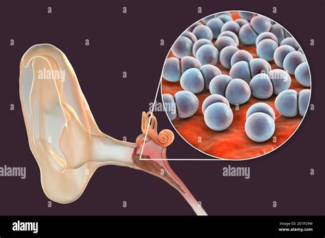 Otitis Media Infección Del Oído Ilustración Fotografía De Stock Alamy