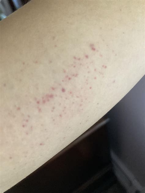 What Is This Rash Rdermatologyquestions