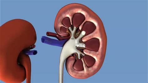 Ureteroscopy Explained For Removal Of Kidney Stone Youtube