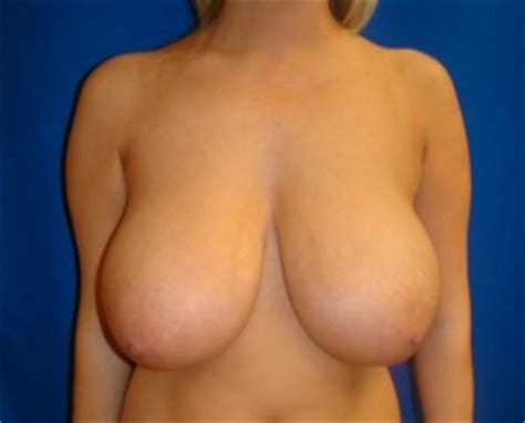 Boob Reduction Before And After Top Porn Photos Boobs
