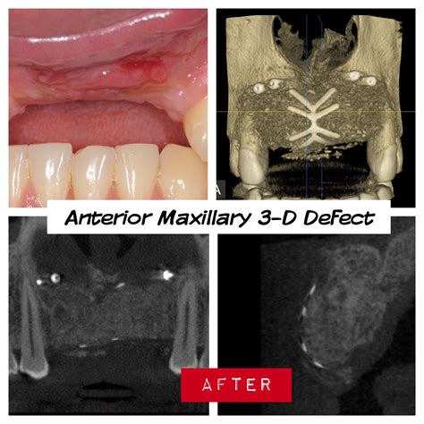 6 Anterior Maxilla Defect After Failed Bone Graft Complications Kazemi