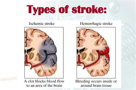 Stroke Causessymptoms And Possible Treatments