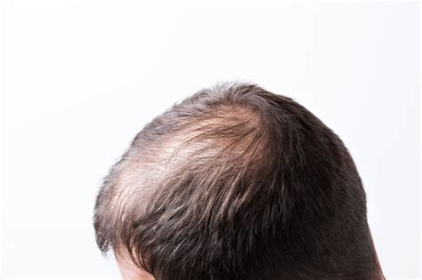 Premium Photo Close Up Balding Head Of A Young Man On A White