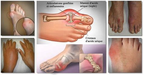 Des Problèmes Comme L’arthrose Ou L’arthrite Sont Des Inflammations Au Niveau Des Articulations