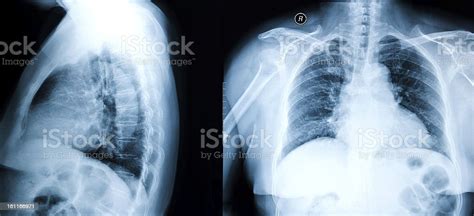 Chest Xray Image Stock Photo Download Image Now Chest Torso