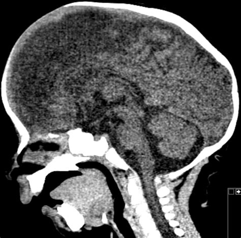 Calvarial Vault Reconstruction For Sagittal Craniosynostosis