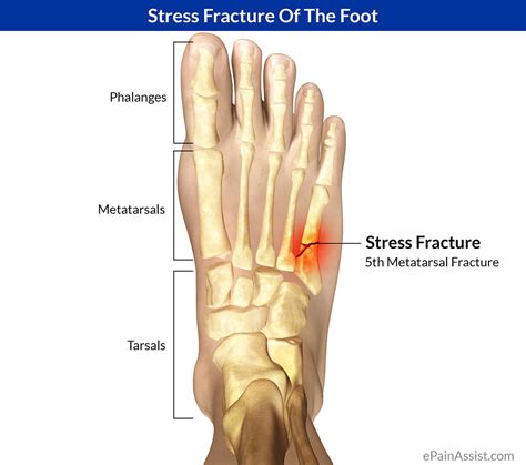 Stress Fracture Of The Footcausessymptomstreatment