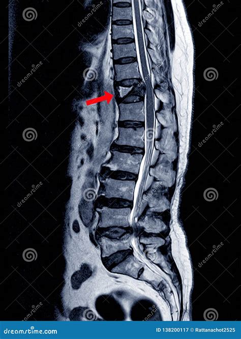 Mri Of Lumbar Thoracic Spine Show Fracture Of Thoraci