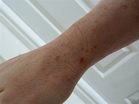 I Have Eczema September 2013