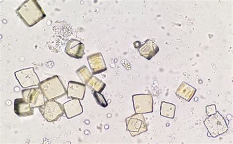A healthcare professional may take a small sample of blood with a needle or ask the person. Uric acid crystals, urine specimen : medlabprofessionals