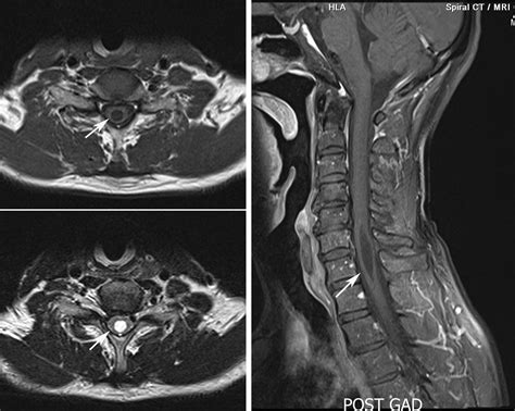 Normal Mri Images Of Cervical Spine