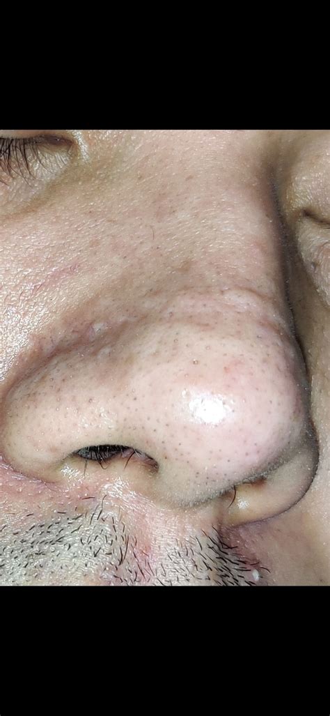 Severe Nose Scar Scar Treatments Forum