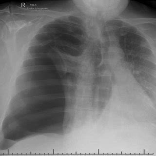 Chest X Ray Demonstrating A Basally Placed Intercostal Chest Drain With