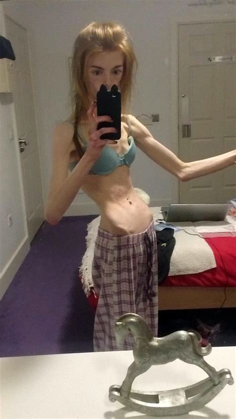 Former Anorexic Whose Weight Plummeted To Stone Describes How