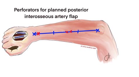 Flap Illustrations James Henderson Specialist Plastic Hand Surgeon