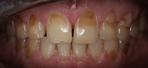 Acid Erosion Causes Tooth Enamel Erosion Smile Kyle NEO Dentistry