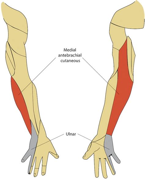 Differentiating C8t1 Radiculopathy From Ulnar Neuropathy A Survey Of