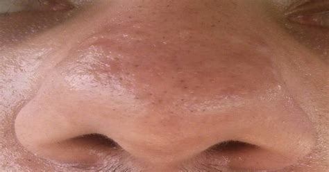 Skin Concerns Raised Bumps From Old Acne That Just Wont Go Away