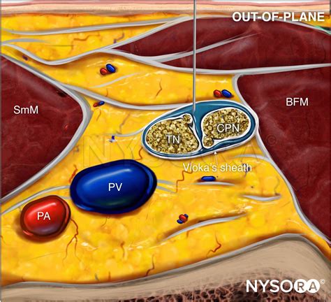 Ultrasound Guided Popliteal Sciatic Nerve Block Nysora Nysora