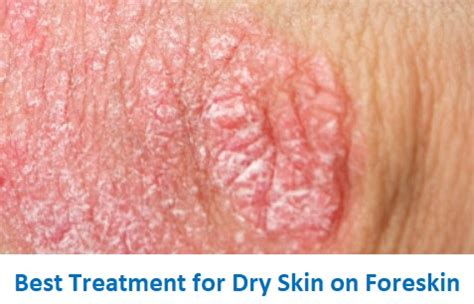 Dry Penis Skin And Peeling Foreskin Treatments Look Here