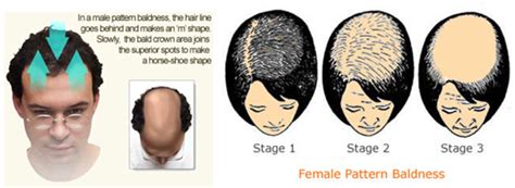 new image hair clinic male vs female pattern baldness