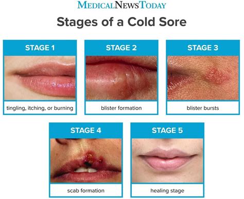 How Long Is Cold Sores Contagious Hutomo