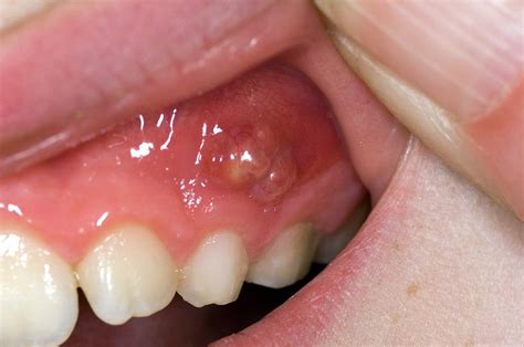 Dental Abscess In A Child Photograph By Dr P Marazziscience Photo Library