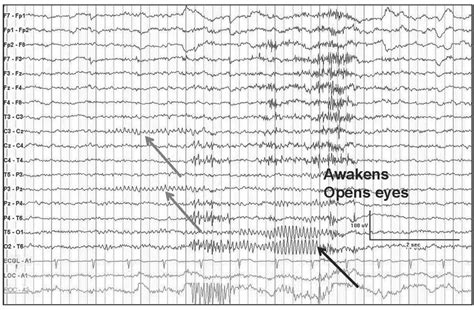 Normal Versus Abnormal Eeg