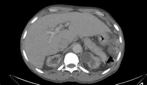 Figure 2 Ct Abdomen And Pelvis With Iv Contrast With Evidence Of