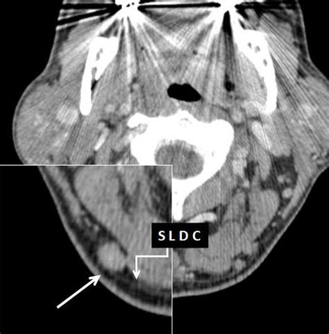 Occipital Lymph Node Location