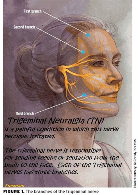 What Is Trigeminal Neuralgia What Causes Trigeminal Neuralgia