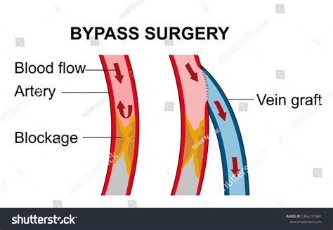 Vascular Bypass Surgery Routes Blood Flow Stock Illustration 1366151981