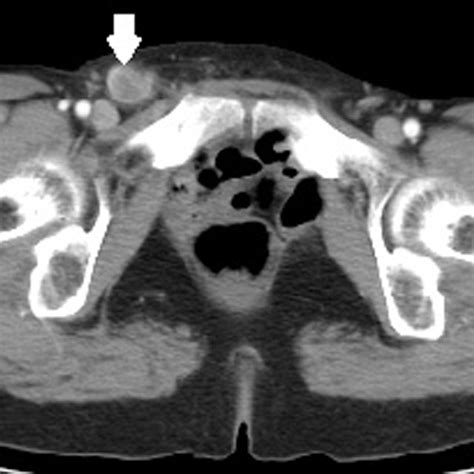 Computed Tomography Ct Scan Of The Abdomen And Pelvis Demonstrating
